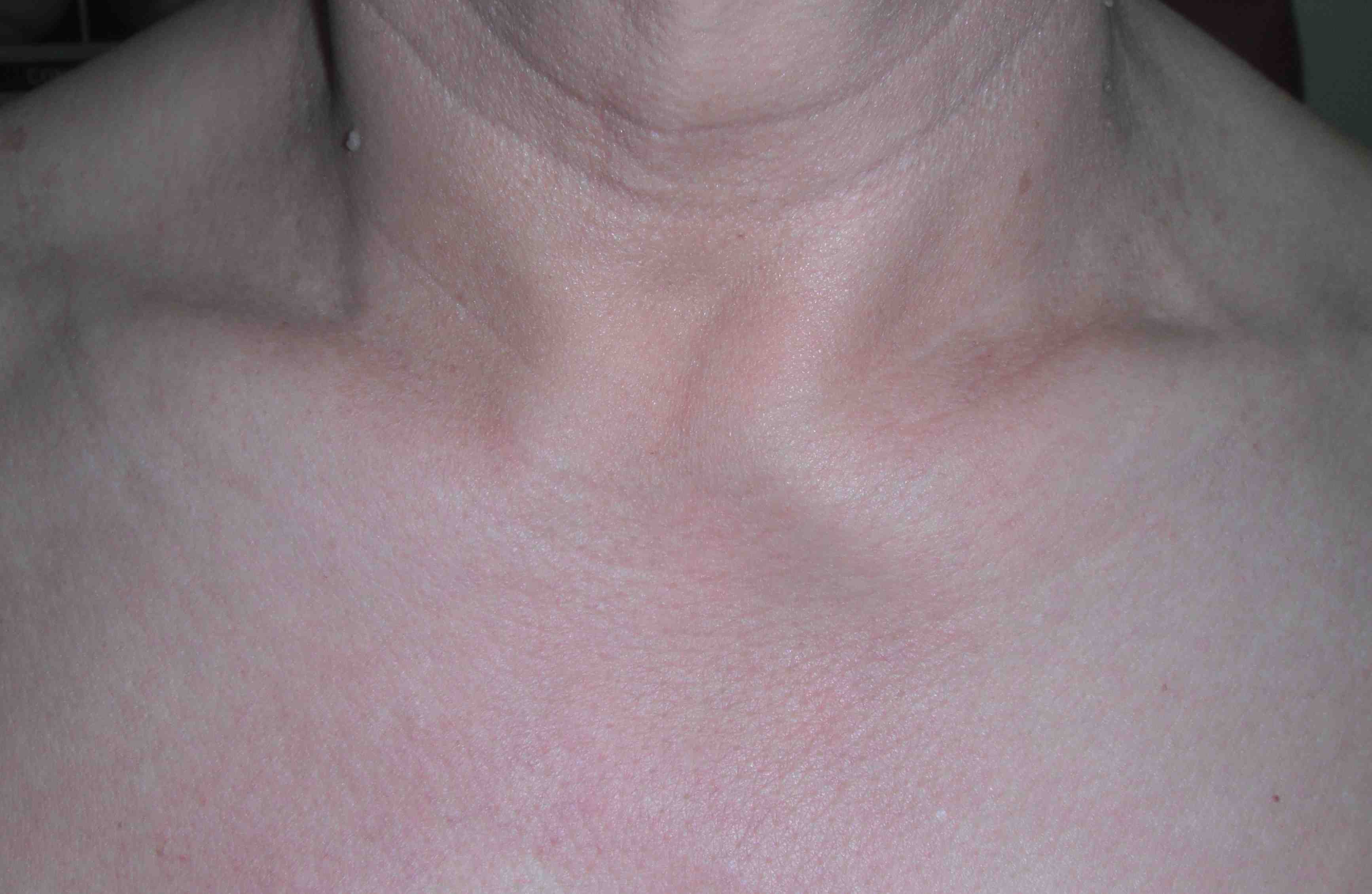 Sternoclavicular OA